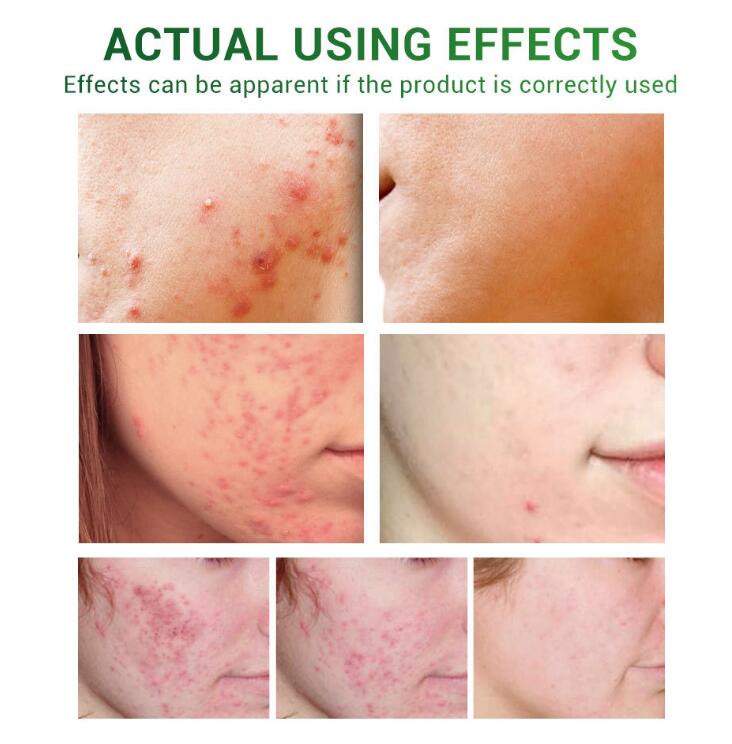 Acne Scar Repair Serum