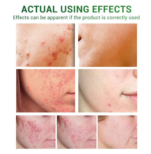 Acne Scar Repair Serum